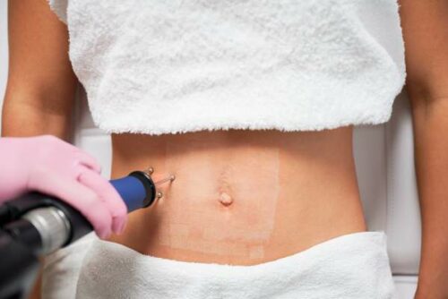 treatment-of-abdominal-skin-imperfections-by-laser-2022-06-20-05-30-19-utc (1)